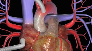 Cirurgia de Revascularização do Miocárdio CRM [upl. by Yarased126]