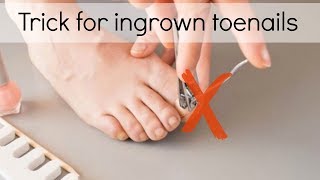 How to Fix Ingrown Toenails Easily [upl. by Sidnac]