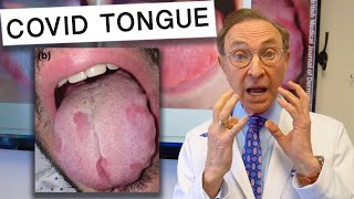 What is COVID Tongue [upl. by Pradeep]