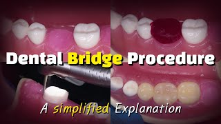 Dental Bridge Procedure [upl. by Yarahs]