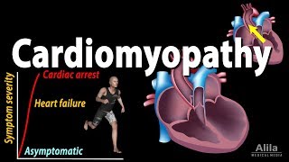 Cardiomyopathy animation [upl. by Erodavlas]