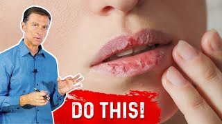 How To Fix Your Chapped Lips – DrBerg On Remedy For Chapped Lips [upl. by Athelstan258]