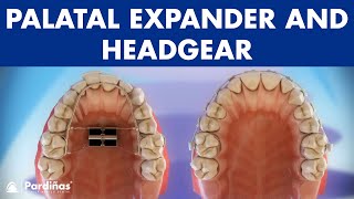 Orthodontic devices  Palatal expander and headgear © [upl. by Zere631]