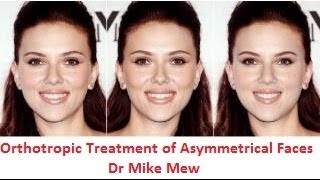 Treatment of Retruded JawsMandible Using GenioplastyMentoplastyChin Augmentation by Dr Mike Mew [upl. by Leith]