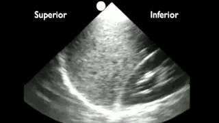Anleitung Ultraschallerkennung von Pleuraflüssigkeit [upl. by Feirahs670]