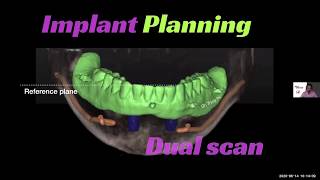 Implant Overdenture Treatment Planning Surgical and Restorative Guidelines [upl. by Acinimod]