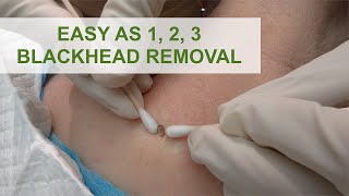 Easy as 1 2 3 Blackhead Removal  Dr Derm [upl. by Ettevram]