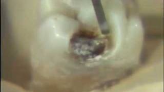 Removal of Carious Lesion [upl. by Merrell]