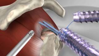 Knotless Rotator Cuff Repair with Arthrex® SpeedFix™ [upl. by Susannah116]